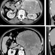 中南大学湘雅二医院李源团队成功救治两例巨大肾上腺皮质腺癌患者