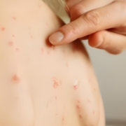 麻疹已接近消除,公众为什么仍要做好预防?