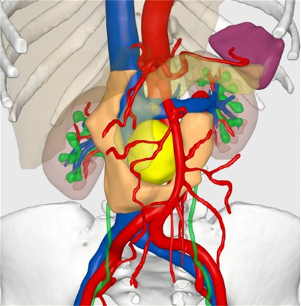 肿瘤位于腔静脉与腹主动脉之间,周围被十二指肠、胰腺、肾静脉、肠系膜动脉包绕.jpg 肿瘤位于腔静脉与腹主动脉之间,周围被十二指肠、胰腺、肾静脉、肠系膜动脉包绕.jpg