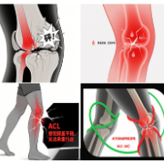 健康科普｜春季重返运动，你膝关节的“安全带”准备好了吗？