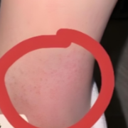 过敏高发，这些问题需了解