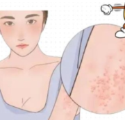 过敏季难熬？中医有妙招