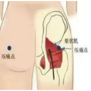 屁股痛腿发麻，腰却不疼？当心梨状肌在“作祟”！
