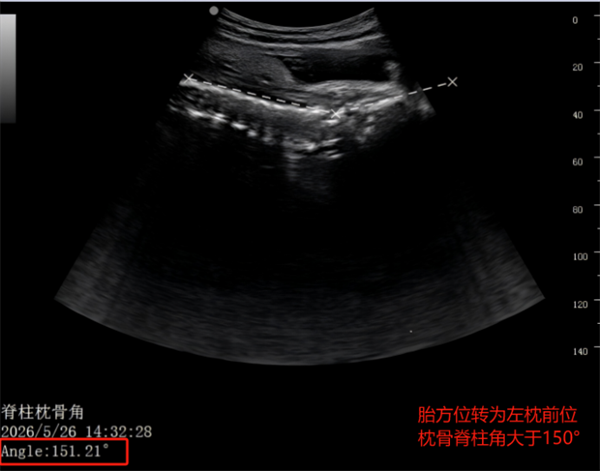 【投】“仰面”枕后位?产时超声+体位调整,一次“顺转剖”的完美逆袭!1310.png 【投】“仰面”枕后位?产时超声+体位调整,一次“顺转剖”的完美逆袭!1310.png