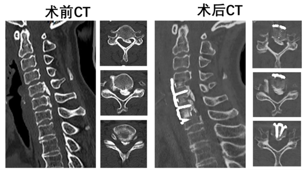 湘雅医院开展湖南省首例胸椎前移治疗多节段胸椎 OPLL手术1482.png 湘雅医院开展湖南省首例胸椎前移治疗多节段胸椎 OPLL手术1482.png