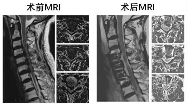 湘雅医院开展湖南省首例胸椎前移治疗多节段胸椎 OPLL手术1480.png 湘雅医院开展湖南省首例胸椎前移治疗多节段胸椎 OPLL手术1480.png