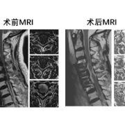 中南大学湘雅医院开展湖南省首例胸椎前移治疗多节段胸椎 OPLL手术