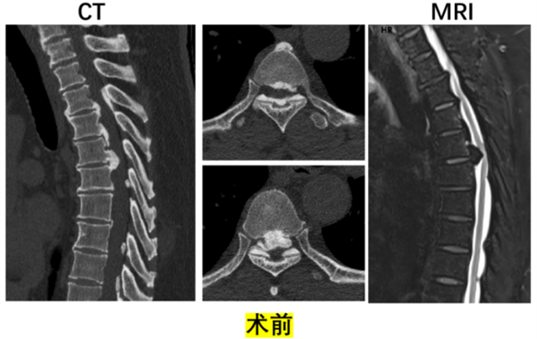 湘雅医院开展湖南省首例胸椎前移治疗多节段胸椎 OPLL手术201.png 湘雅医院开展湖南省首例胸椎前移治疗多节段胸椎 OPLL手术201.png