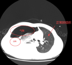 高三少年突发血气胸 紧急手术转危为安