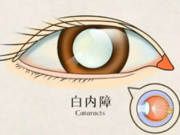 飞秒激光辅助白内障手术 助力化解疑难眼病