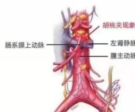 孩子患上“胡桃夹综合征” 医生叮嘱：长胖点！