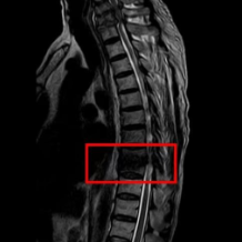腰背疼痛不可一“贴”了之 警惕脊柱结核导致瘫痪