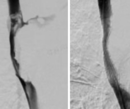 手和脸突然肿了?可能是这根血管堵了