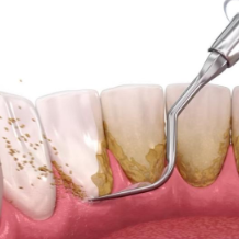 健康科普丨牙结石有哪些危害？