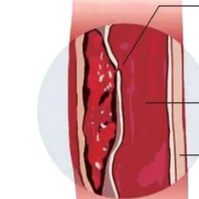 防寒更要防病!医生提醒:别让低温“冻”破主动脉