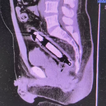 直肠异物不可小视!男子塞入近20厘米金属物险酿大祸