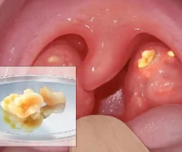 扁桃体上也长“石头”?男子喉咙异物、口臭元凶竟是它