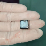 8岁男童误吞磁铁 长沙市第四医院胃镜微创手术化险为夷