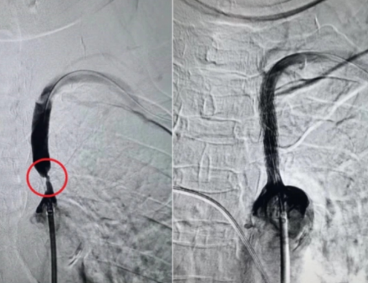 双臂血压差太多?当心是“偷血大盗”在作怪!