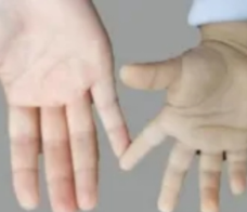 孩子手心发白、注意力差?警惕缺铁性贫血!