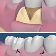 牙周炎治疗就是洗牙?别再误解啦!