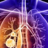 检出肺结节 不必成心结