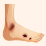 中疾控:糖尿病足不只是“脚出了点小毛病”