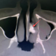 一颗牙齿“跑”进鼻腔?专家提醒:异常鼻塞需警惕异位牙