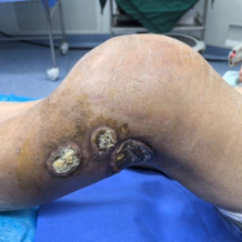 膝关节反复肿痛别大意!警惕“啃骨”结核!