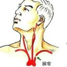 手臂无力还头晕?当心是血管在“盗血”