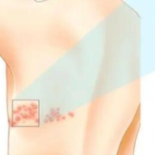 带状疱疹悄悄缠上年轻人,做好4件事,守护健康不踩坑