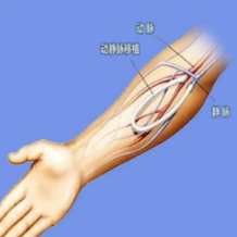 长沙市中医医院为透析患者带回“国家级”血管通路技术