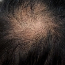 脱发后该怎么把头发养回来?专家支招