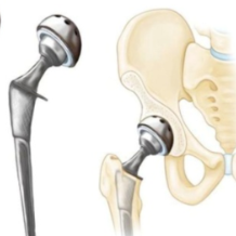 75岁老人遇“人生最后一次骨折”,微创换髋重获行走自由