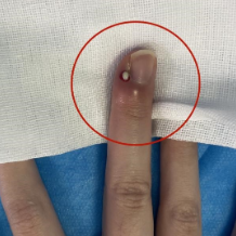 小小倒刺竟导致手指化脓?医生提醒:处理倒刺要当心!