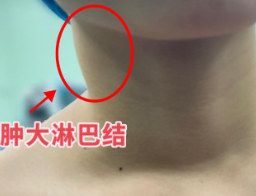 13岁女孩确诊甲状腺癌！警惕脖子上这种“小疙瘩”