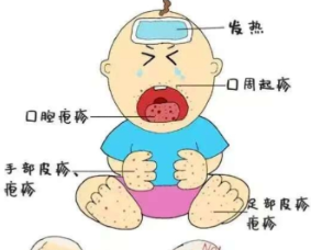 面对手足口病，你还是“手足无措”吗？