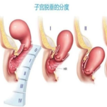 子宫脱垂引发险情，多学科合作助九旬老人脱险