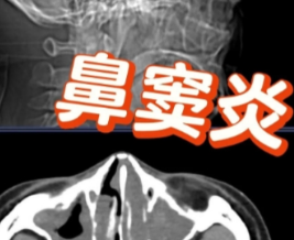 儿童鼻窦炎做CT？可能根本不需要