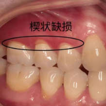 刷牙刷出“坑”？可能是“楔状缺损”在作祟