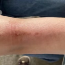 健康科普 | 透析患者夏季如何预防瘙痒