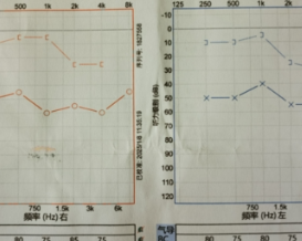 耳朵里的骨头“长歪了”？人工听骨植入，重建听力