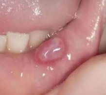 健康科普丨当心孩子唇内的“小水泡”：黏液腺囊肿的原因与治疗