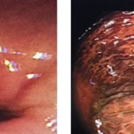 通便药当“减肥药”长期服用，37岁女子吃出结肠黑变病