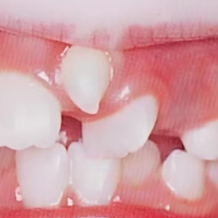 牙齿松动=要拔牙?专家详解:这5类情况,拔比留更明智!