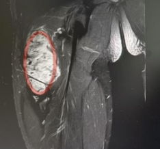 不致命但难缠!带你认识侵袭性纤维瘤