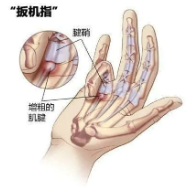 手机刷不停?当心“扳机指”找上门!