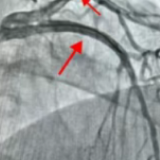 “金刚钻”联手“冲击波”,湖南省康复医院医护巧破冠脉“钢筋铁骨”