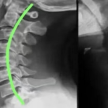 告别颈椎疼痛!疼痛科医生教你科学“治痛”不踩雷
