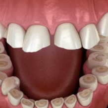 健康科普丨专家揭秘“咬合重建”：如何为磨损牙齿“重启人生”